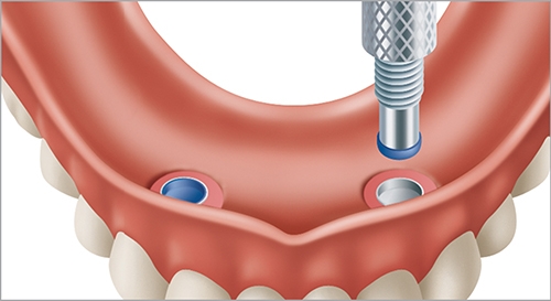 Close-up of a retentive insert inside a denture