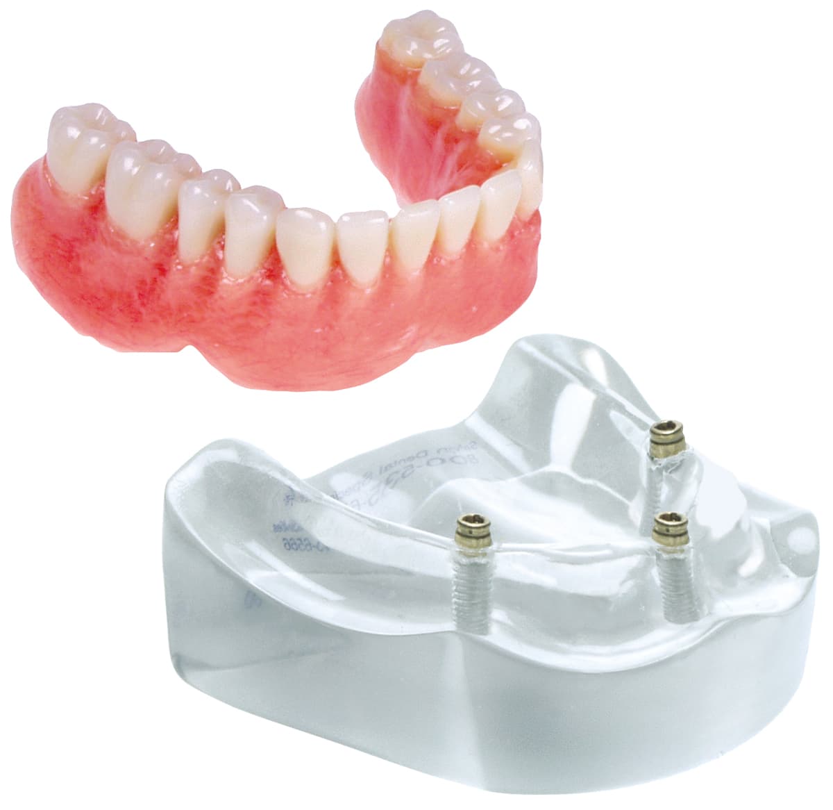 Demonstration model of a removable denture supported by three implants